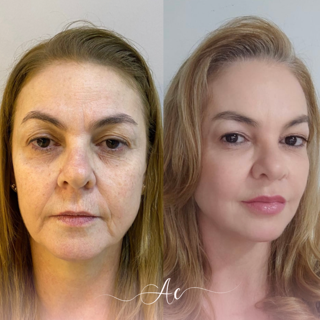 Resultados personalisados (Post do Instagram) - 17